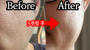 비타민C 메가도스 시작 전(왼쪽)과 3개월 후(오른쪽) 뺨 피부 클로즈업 비교. 직접 촬영, 얼굴 식별 불가 부위